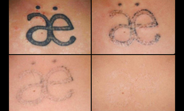 Tatoeage verwijderen - Beauty-Tech